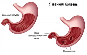 Диетическое питание при язве желудка