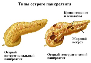 Панкреатит бывает двух видов.